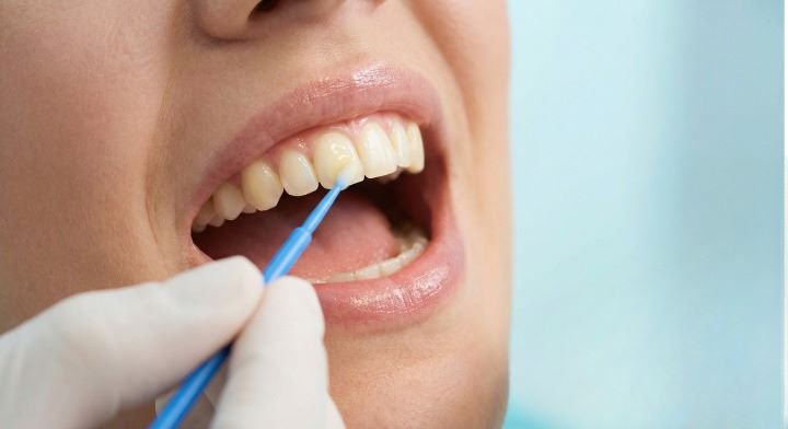 Fluoride Treatment protective varnish applied to adult teeth by a dentist at Yonge Wellesley Dental in Toronto