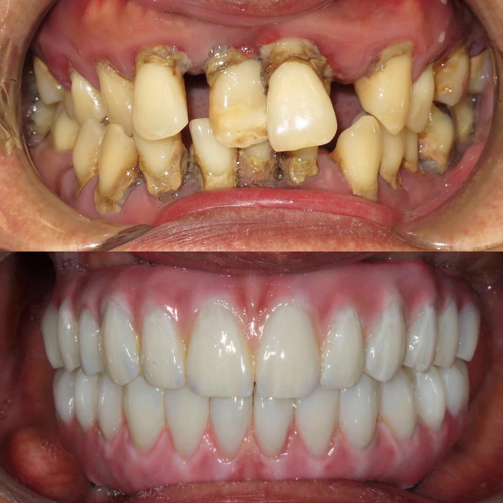 All on 4 dental implants - Yonge Wellesley Dental, Toronto