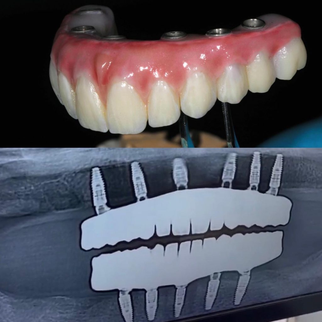 All on 4 dental implants - Yonge Wellesley Dental, Toronto